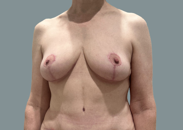 Breast Lift result at La Femme Plastic Surgery