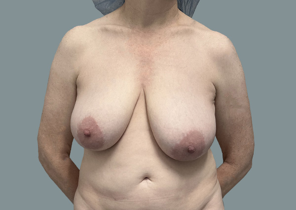 Breast Lift before photo
