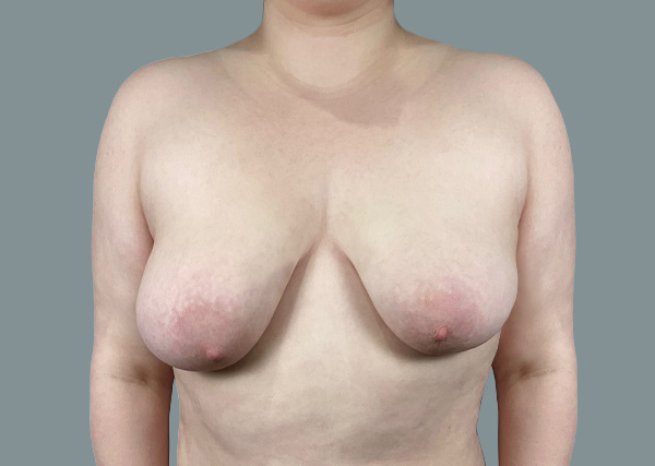 Breast Augmentation before photo