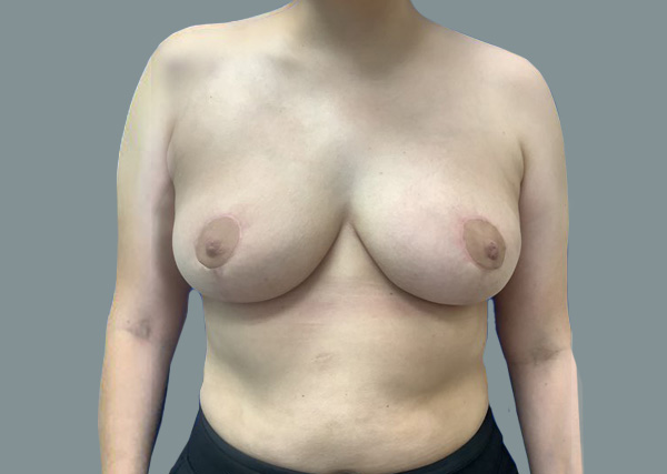 Breast Lift result at La Femme Plastic Surgery