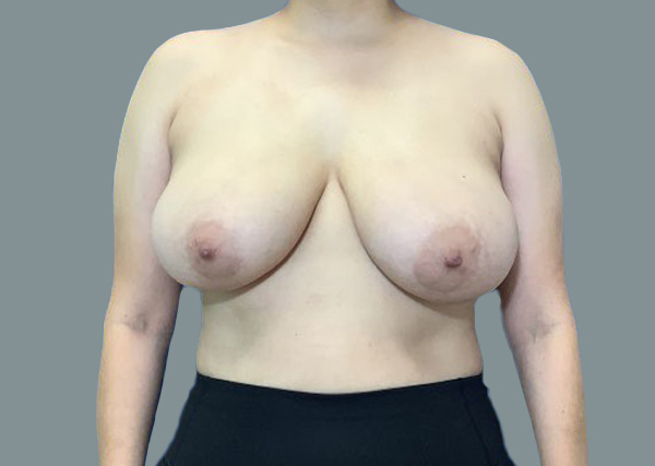 Breast Lift before photo