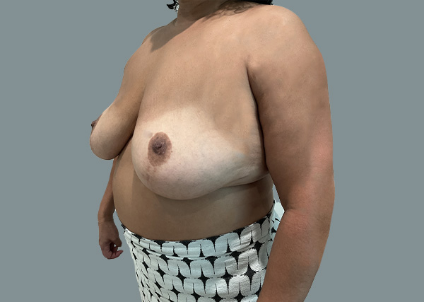 Implant Revision result at La Femme Plastic Surgery