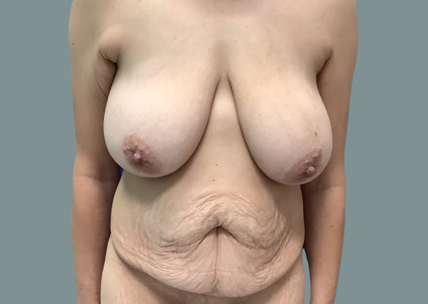Breast Augmentation before photo