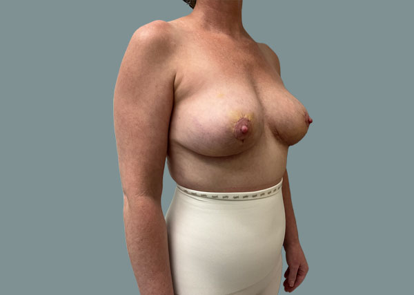 Implant Revision result at La Femme Plastic Surgery