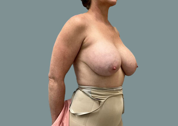 Implant Revision before photo