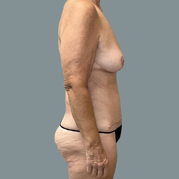 Mommy Makeover result at La Femme Plastic Surgery