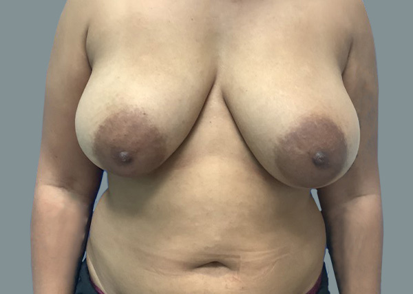 Breast Reduction before photo