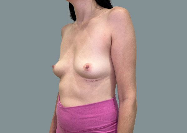 Implant Revision result at La Femme Plastic Surgery