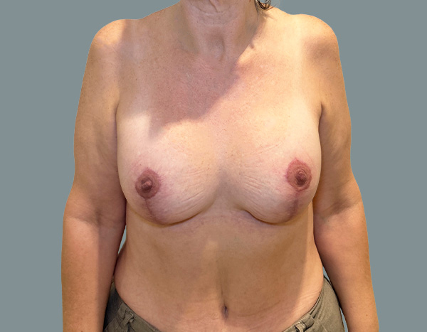 Breast Augmentation result at La Femme Plastic Surgery