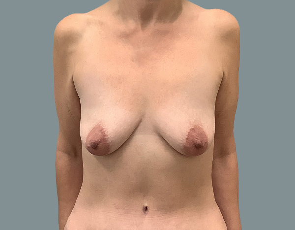 Breast Augmentation before photo