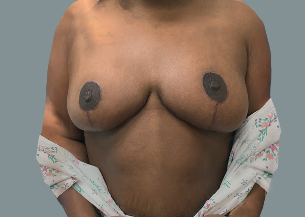 Breast Lift result at La Femme Plastic Surgery