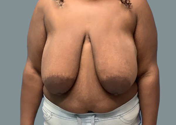 Breast Lift before photo