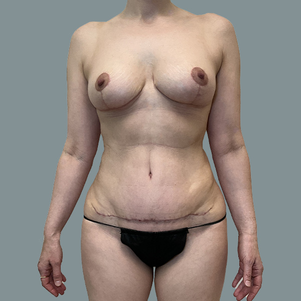 Mommy Makeover result at La Femme Plastic Surgery