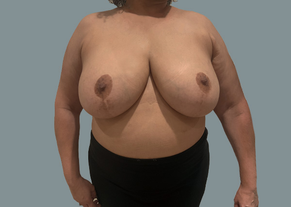 Implant Revision before photo