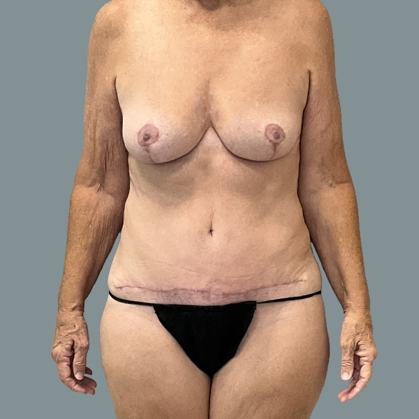 La Femme Plastic Surgery mommy makeover after — Las Vegas, NV