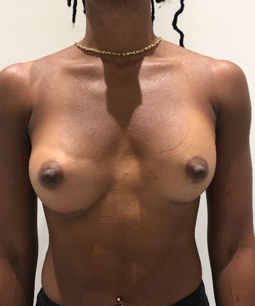 Breast Augmentation result at Gables Plastic Surgery