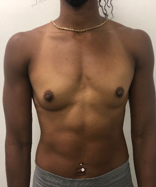 Breast Augmentation before photo