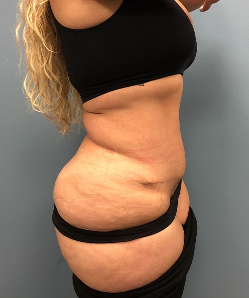 A result from Gables Plastic Surgery