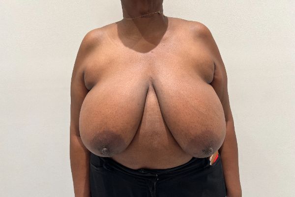 Breast Reduction before photo