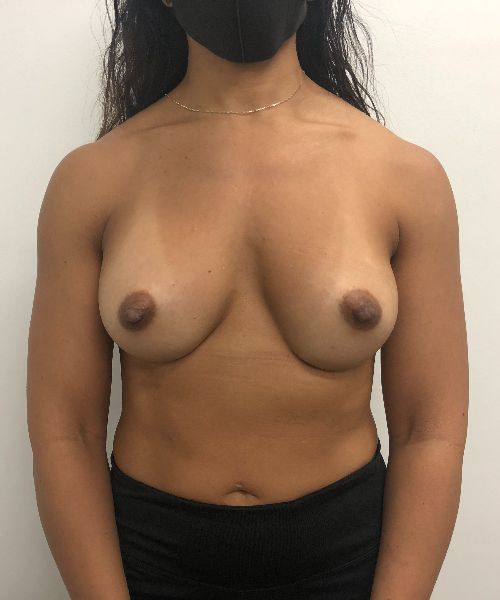 Breast Augmentation result at Gables Plastic Surgery