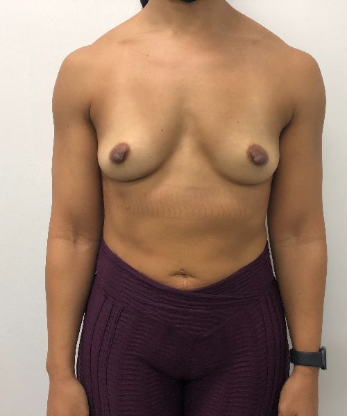 Breast Augmentation before photo