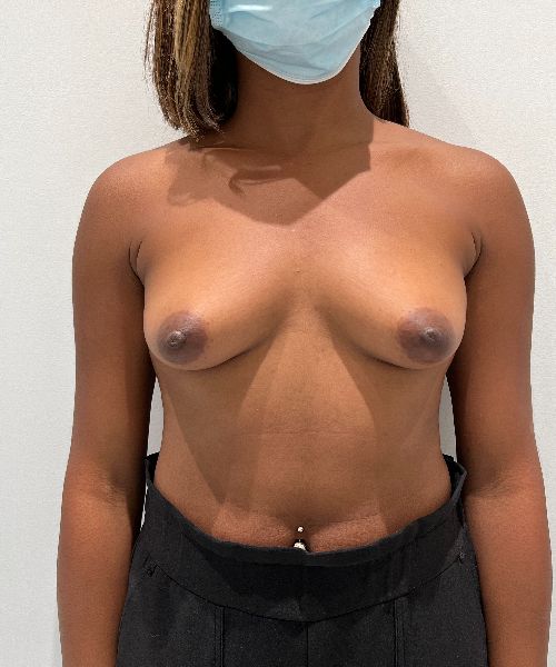 Breast Augmentation before photo