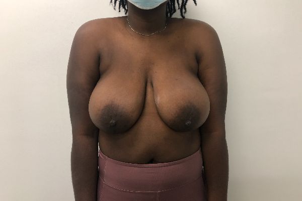 Breast Reduction before photo