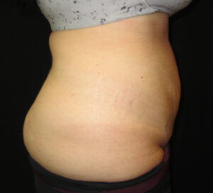 A result from Port City Plastic Surgery - Charleston
