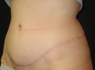 A result from Port City Plastic Surgery - Charleston