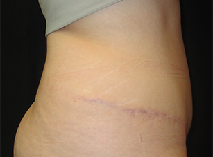 A result from Port City Plastic Surgery - Charleston