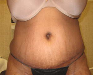 A result from Port City Plastic Surgery - Charleston