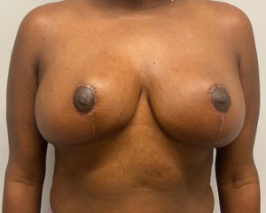 A result from Port City Plastic Surgery - Charleston