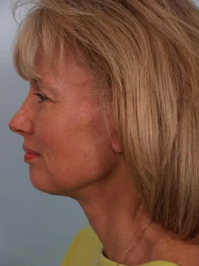 Dr. Robert Cohen facelift after — Santa Monica, CA
