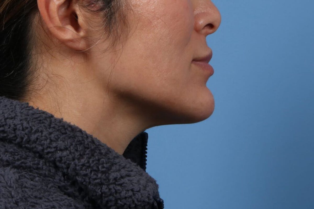 A result from Basu Plastic Surgery