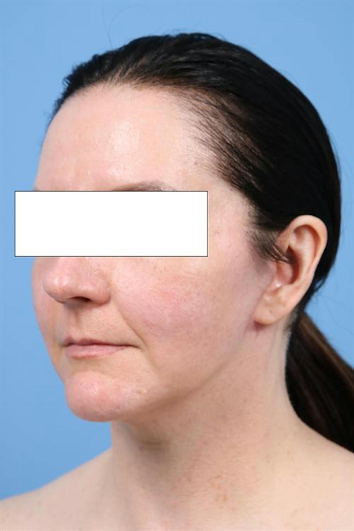 A result from Basu Plastic Surgery
