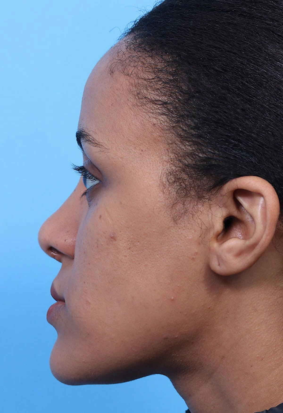 A result from Basu Plastic Surgery
