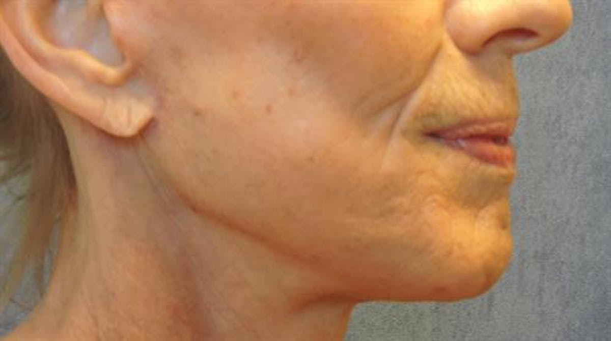 A result from Basu Plastic Surgery