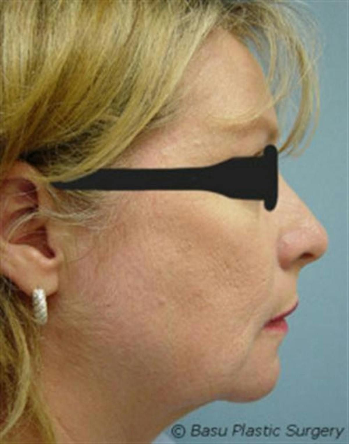 A result from Basu Plastic Surgery