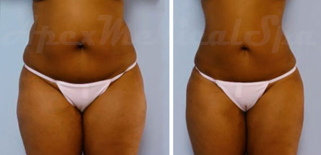 A result from Apex Medical Spa