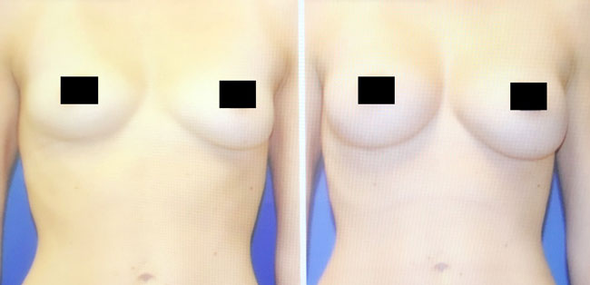 A result from Apex Medical Spa