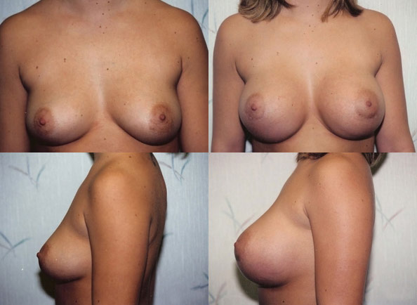 Breast Augmentation result at Daniel J. Casper, M.D.