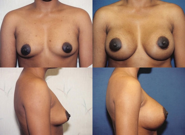 Breast Augmentation result at Daniel J. Casper, M.D.