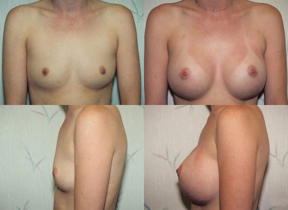 Breast Augmentation result at Daniel J. Casper, M.D.