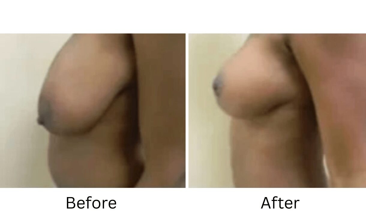 A result from Image Cosmetic Surgery Center