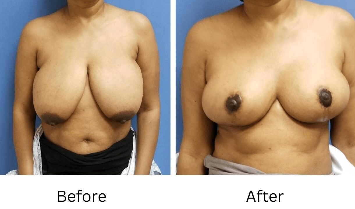 A result from Image Cosmetic Surgery Center