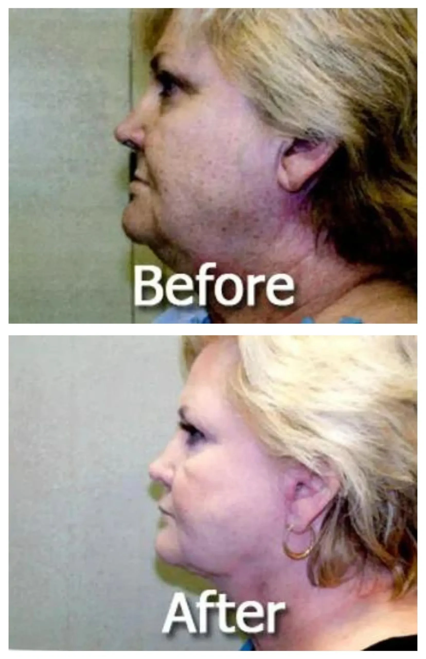 A result from Image Cosmetic Surgery Center
