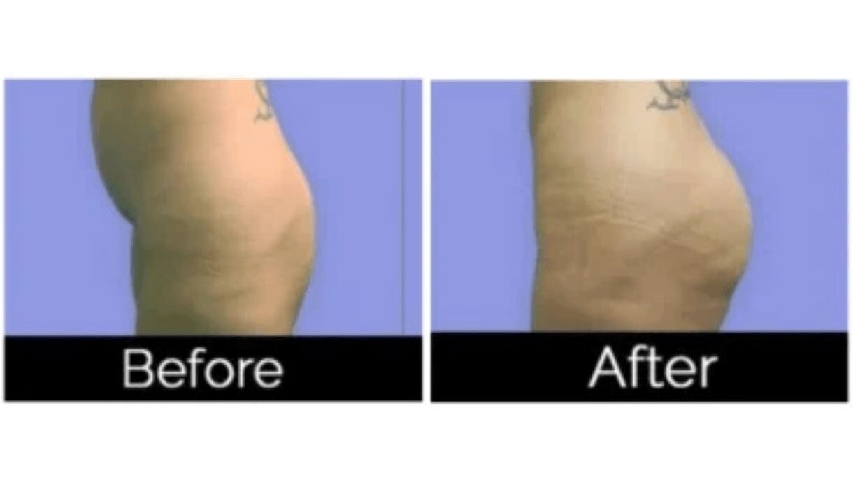 A result from Image Cosmetic Surgery Center
