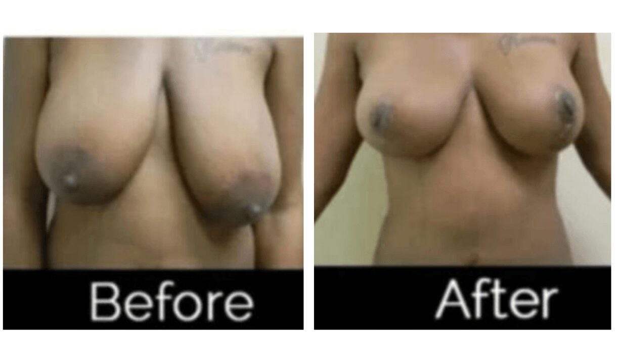 A result from Image Cosmetic Surgery Center
