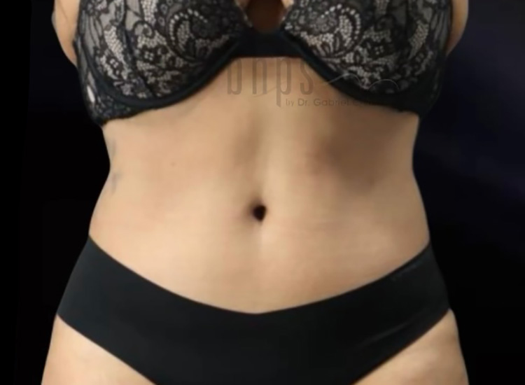 Beverly Hills Plastic Surgery liposuction after — Beverly Hills, CA