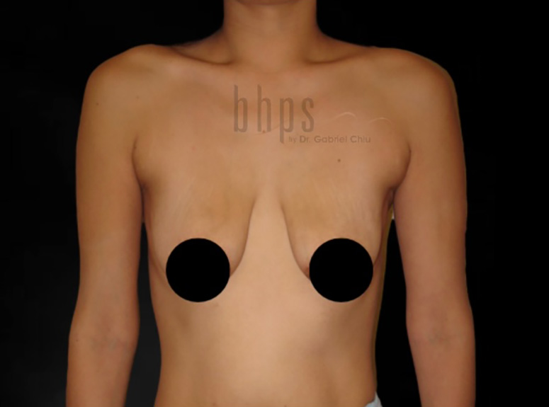 Procedure before photo